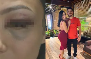 Mulher é espancada por namorado e pode perder o olho; agressor é servidor do TJ-PI (Foto: Reprodução)