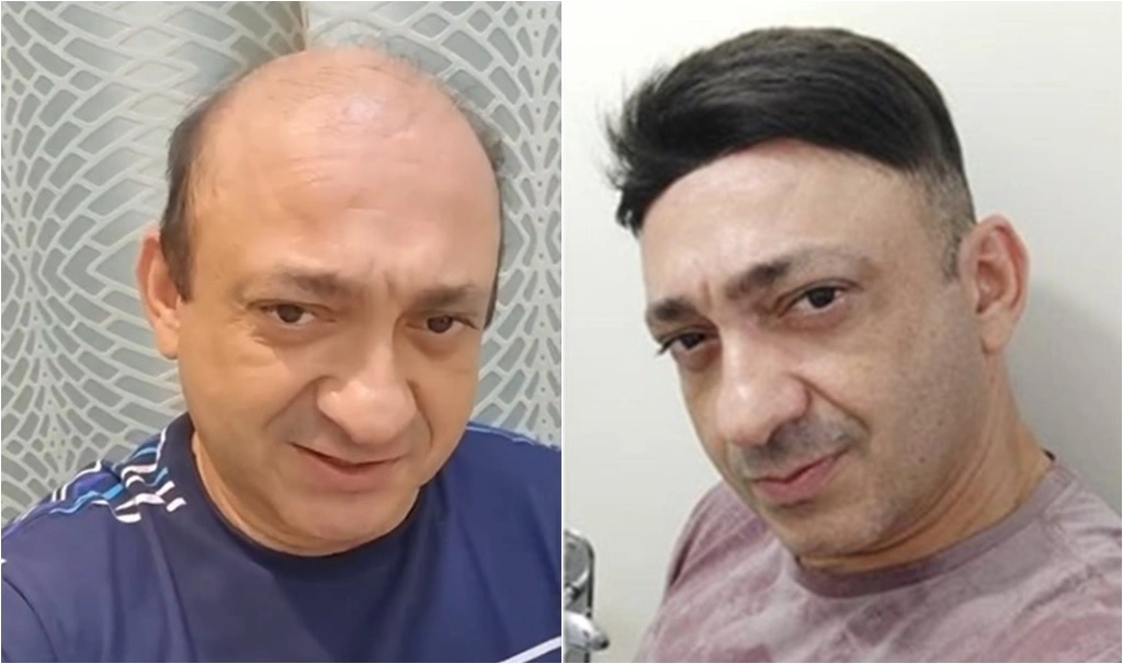 Beto Rego atualmente e quando testou uma prótese capilar