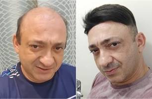 Beto Rego atualmente e quando testou uma prótese capilar (Foto: Reprodução)