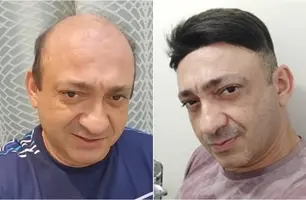 Beto Rego atualmente e quando testou uma prótese capilar (Foto: Reprodução)