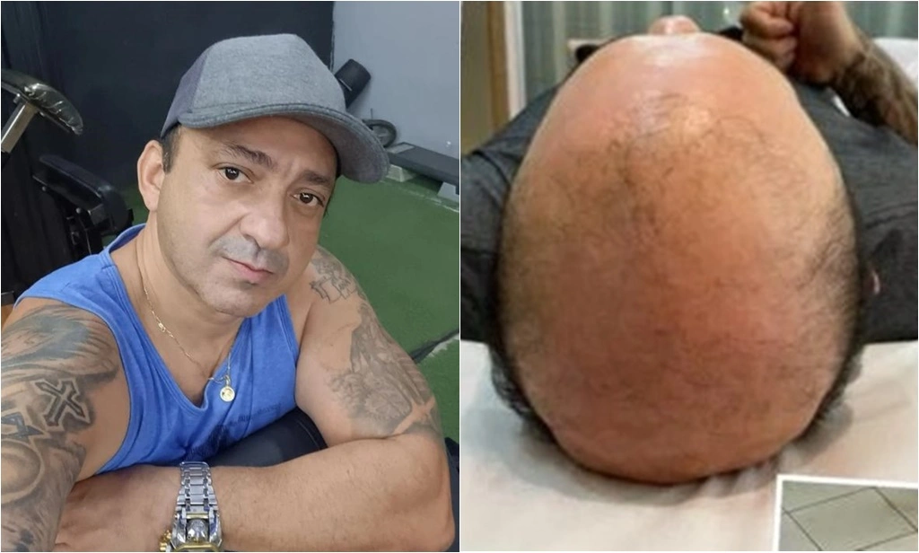 Beto Rego atualiza sobre tratamento contra a 'carequice'