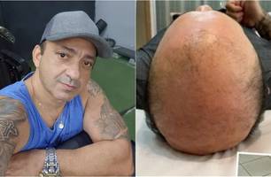 Beto Rego atualiza sobre tratamento contra a 'carequice' (Foto: Reprodução/Redes sociais)