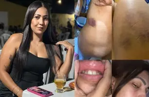 Mulher expõe hematomas de agressão e ameaças do ex-namorado barman em Teresina (Foto: Reprodução)