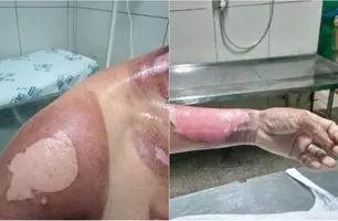 Vítima teve mais de 20% do corpo queimado (Foto: Reprodução)