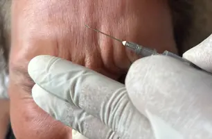 Aplicação da toxina botulínica (Foto: Conecta Piauí)