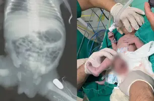 Grávida é atingida por tiro que fica alojado na perna do bebê no Maranhão (Foto: Reprodução)