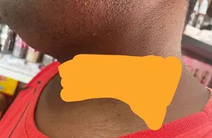 Homem tem pescoço cortado por linha com cerol e quase morre em São Raimundo Nonato (Foto: Reprodução)