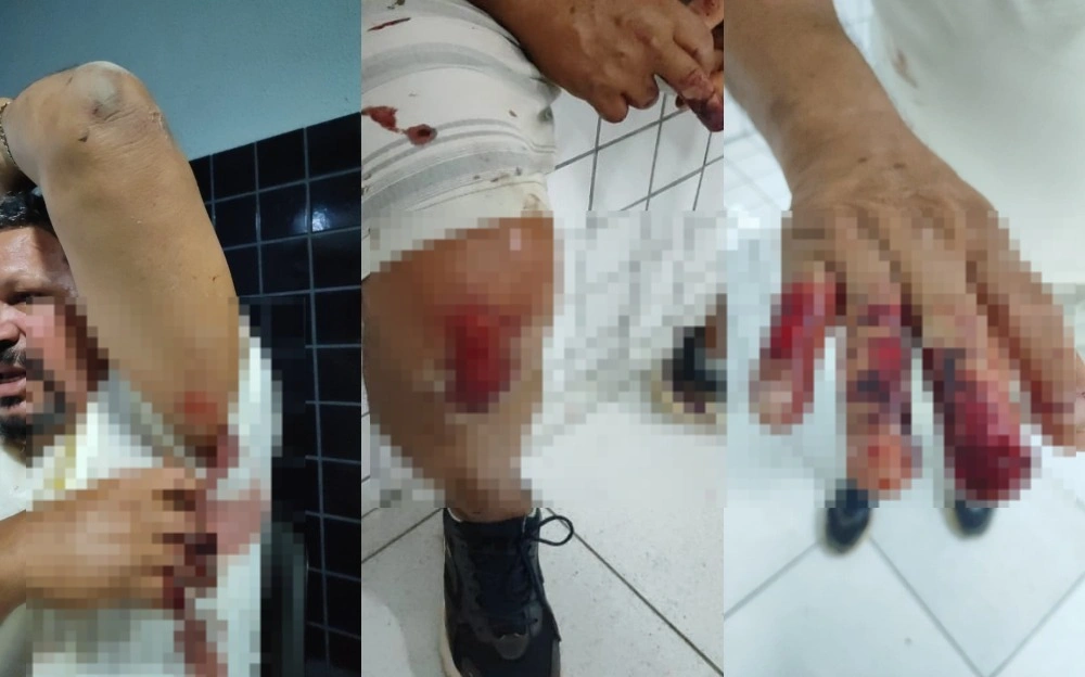 Homem sofre lesões graves após ser atacado em bar em Luis Correia