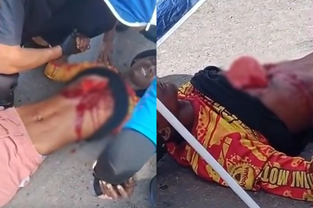 Motociclista fica com pulmão exposto após grave acidente no Maranhão