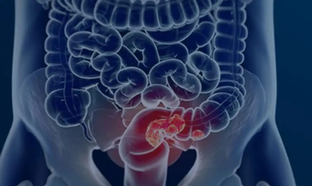 Pacientes com câncer colorretal são diagnosticados em estágio avançado