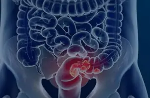 Pacientes com câncer colorretal são diagnosticados em estágio avançado (Foto: Câmara Municipal de Afonso Claudio/ Divulgação)