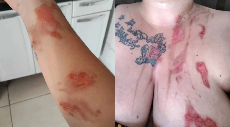 Panela de pressão explode e deixa mulher ferida no Piauí