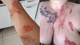 Panela de pressão explode e deixa mulher ferida no Piauí (Foto: Reprodução)