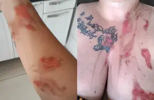 Panela de pressão explode e deixa mulher ferida no Piauí (Foto: Reprodução)