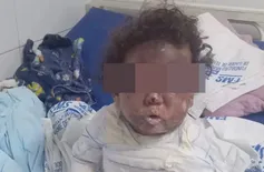 Criança tem corpo queimado em acidente doméstico em cidade do Piauí