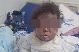 Criança tem corpo queimado em acidente doméstico em cidade do Piauí (Foto: Reprodução)