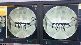 Hospital de Piripiri realiza primeira cirurgia ortopédica de alta complexidade (Foto: Reprodução)