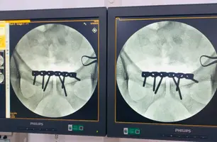 Hospital de Piripiri realiza primeira cirurgia ortopédica de alta complexidade (Foto: Reprodução)