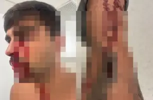 Gustavo terá de fazer um procedimento para recupera o canal lacrimal (Foto: Reprodução)