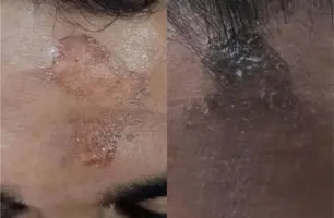 Mistério : Fiéis relatam queimaduras na testa após missa da quarta-feira de cinzas (Foto: Reprodução)