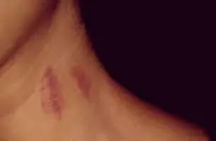 Mulher é diagnosticado com AVC após levar um chupão no pescoço; entenda o caso (Foto: Reprodução)