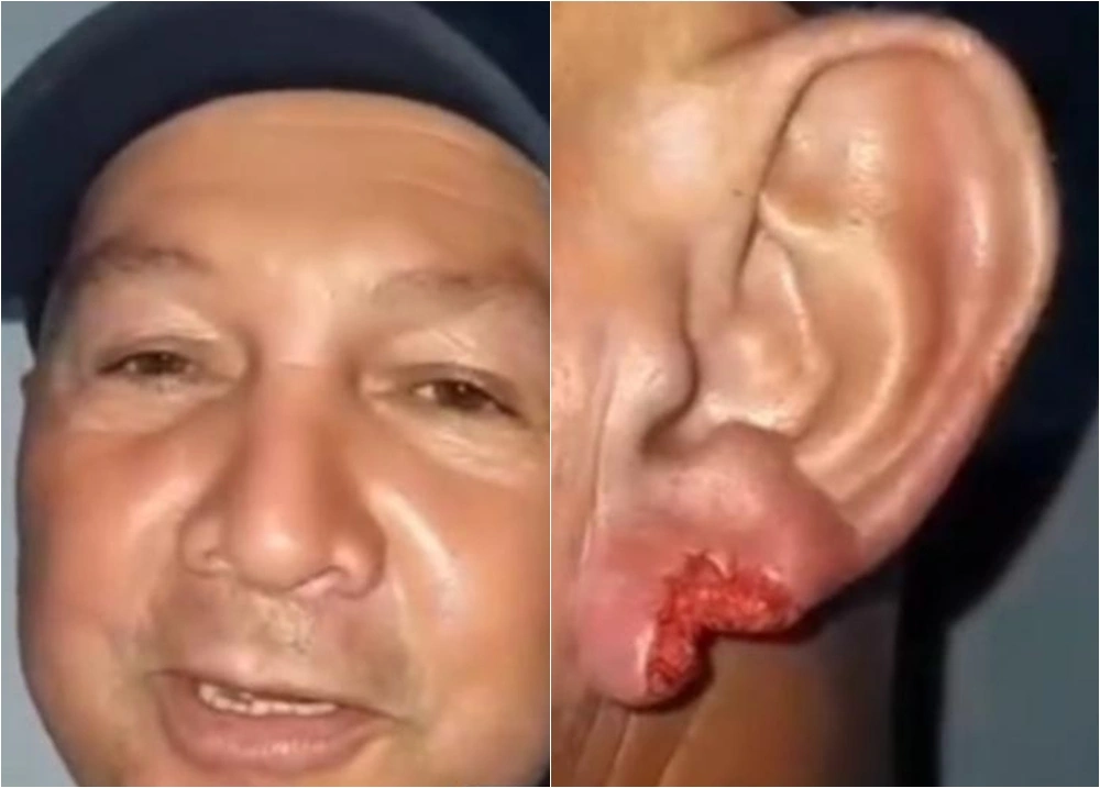 Após beijo, mulher arranca pedaço da orelha de homem durante festa em Piripiri