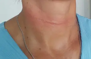 Professora quase é degolada por linha de cerol ao sair para trabalhar em Barras (Foto: Reprodução)