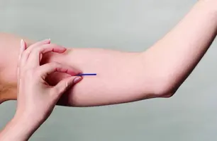 Implanon (Foto: Reprodução/Internet)