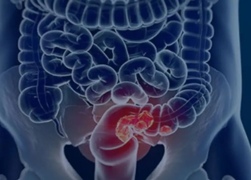 Estudo projeta aumento de 36% em mortes por câncer colorretal até 2040