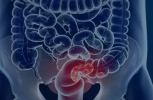 Estudo projeta aumento de 36% em mortes por câncer colorretal até 2040 (Foto: Câmara Municipal de Afonso Claudio/Divulgação)