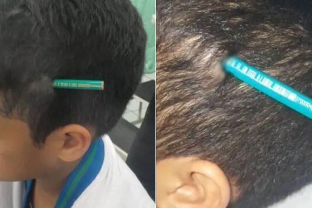 Menino de 9 anos tem lápis cravado na cabeça após agressão em escola de São Paulo