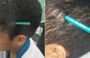 Menino de 9 anos tem lápis cravado na cabeça após agressão em escola de São Paulo (Foto: Reprodução)
