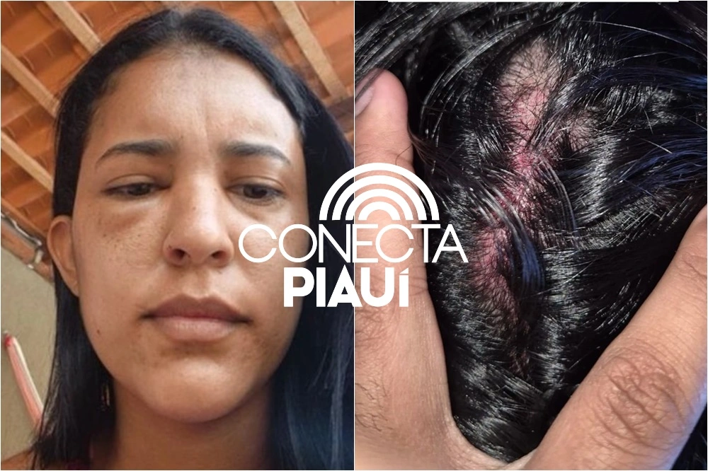 Secretária de Saúde tem casa invadida e é espancada pelo ex-namorado no Piauí