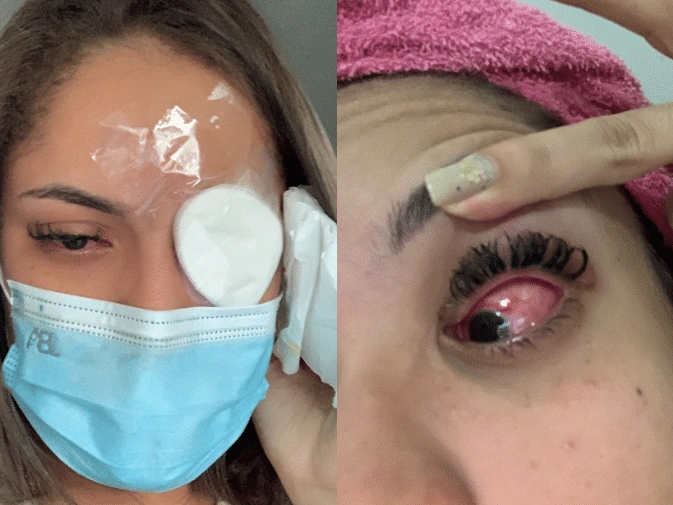 Em 2023, vários casos de cegueira temporária foram registradas no Brasil