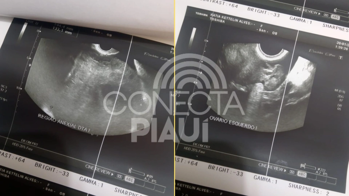 Mãe faz apelo por ajuda para tratamento da filha com cisto de 15 cm