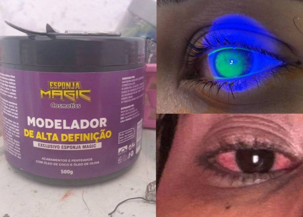 Risco no Carnaval: pomadas de cabelo causam reação em olhos de foliãs no Piauí