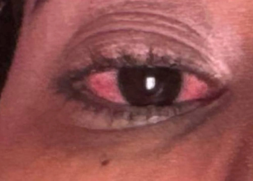 Risco no Carnaval: pomadas de cabelo causam reação em olhos de foliãs no Piauí