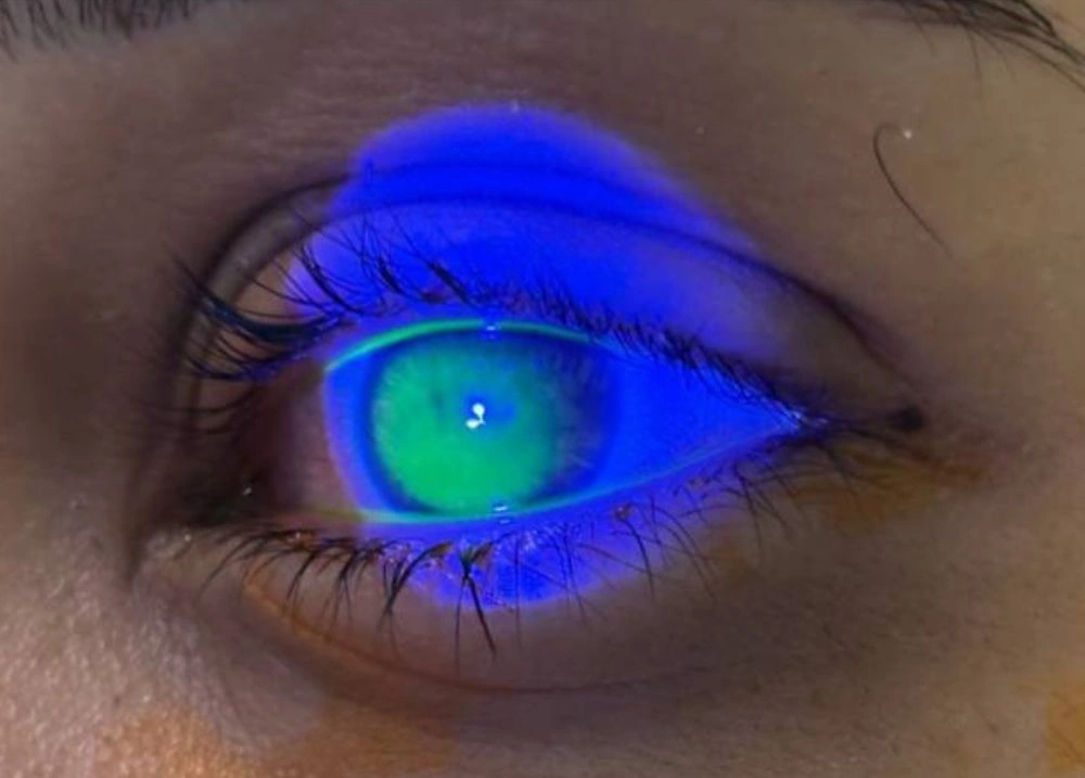 Risco no Carnaval: pomadas de cabelo causam reação em olhos de foliãs no Piauí