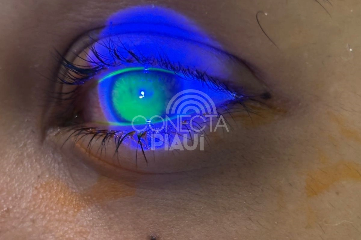 Uso de gel no cabelo causa lesões nos olhos de jovens no Piauí