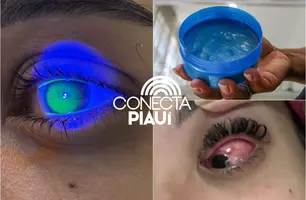 Uso de gel no cabelo provoca lesões nos olhos de jovens em bloquinhos na Grande Teresina (Foto: Reprodução)