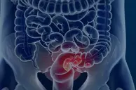 Rastreio e prevenção do câncer de colorretal