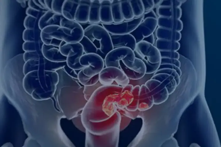 Rastreio e prevenção do câncer de colorretal