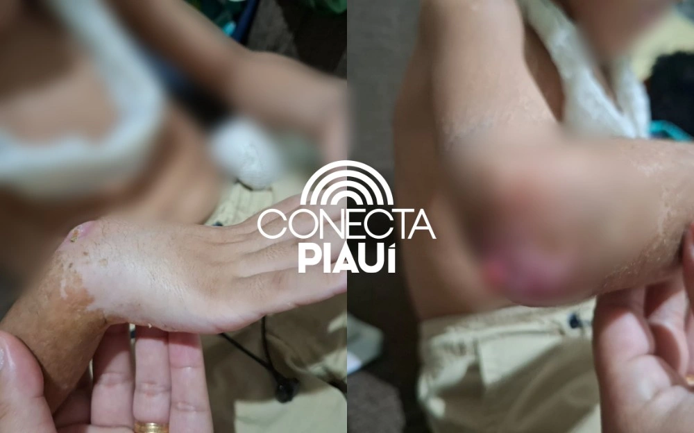 Criança espera cirurgia há 4 meses e pode perder o braço em Teresina