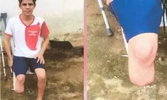 Servidor que amputou o próprio pé para receber indenização foi condenado
