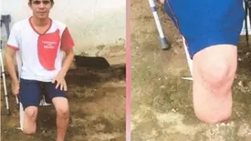 Servidor que amputou o próprio pé para receber indenização foi condenado (Foto: Reprodução)