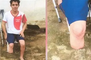 Servidor que amputou o próprio pé para receber indenização foi condenado (Foto: Reprodução)
