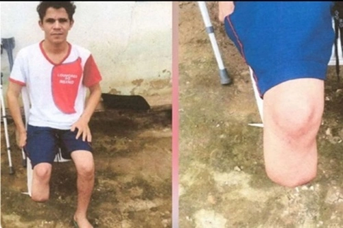 Servidor que amputou o próprio pé para receber indenização foi condenado